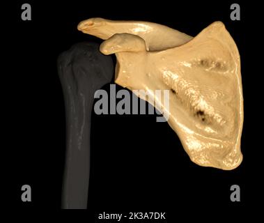 CT Shoulder 3D dell'esame di rappresentazione volumetrica della tomografia computerizzata del rendering della spalla 3D in caso di frattura dell'articolazione della spalla. Foto Stock