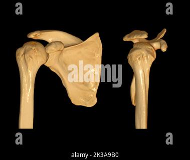 CT Shoulder 3D dell'esame di rappresentazione volumetrica della tomografia computerizzata del rendering della spalla 3D in caso di frattura dell'articolazione della spalla. Foto Stock