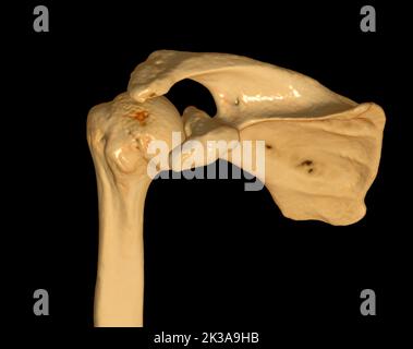 CT Shoulder 3D dell'esame di rappresentazione volumetrica della tomografia computerizzata del rendering della spalla 3D in caso di frattura dell'articolazione della spalla. Foto Stock