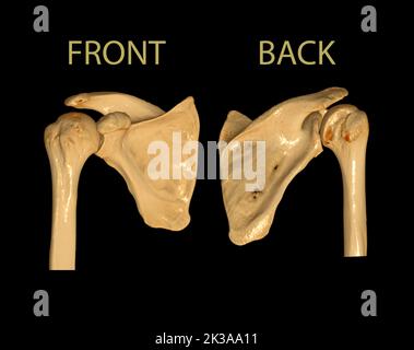 CT Shoulder 3D dell'esame di rappresentazione volumetrica della tomografia computerizzata del rendering della spalla 3D in caso di frattura dell'articolazione della spalla. Foto Stock