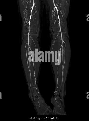 Immagine di scentratura dell'arteria femorale CTA dell'arteria femorale che presenta una malattia arteriosa periferica acuta o cronica. Foto Stock