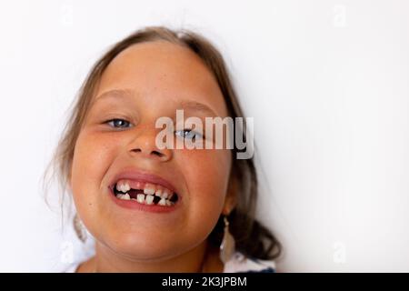 Adorabile ragazza con bocca aperta senza denti con denti temporanei che affollano il latte in studio bianco. Lavoro dentale con morso incrociato Foto Stock