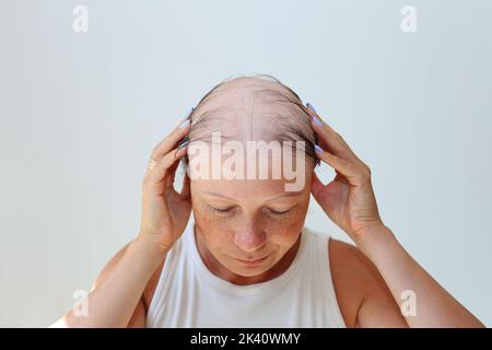 Perdita di capelli sotto forma di alopecia areata. Testa calva di una donna. Diradamento dei capelli dopo il covid. Cerotti calvo di alopecia totale Foto Stock