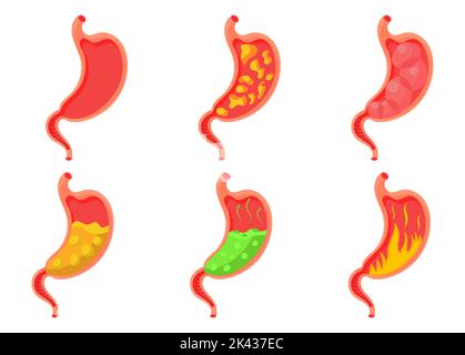 Impostare lo stomaco vuoto e pieno. Pesantezza dello stomaco, gonfiore, dolore nel tratto alimentare e bruciore di stomaco acido. Problemi duodenali e la salute degli organi umani Illustrazione Vettoriale