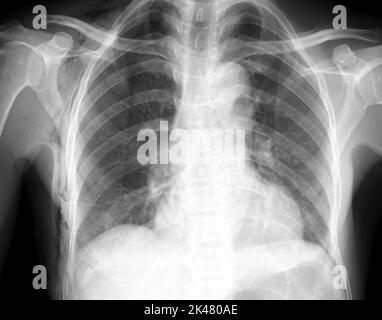Enfisema sottocutaneo, radiografia Foto Stock