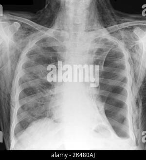 Enfisema sottocutaneo, radiografia Foto Stock