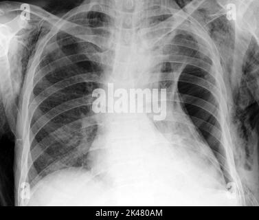 Enfisema sottocutaneo, radiografia Foto Stock