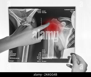 Pellicola radiogena della spalla. Radiografia di lesioni ossee della clavicola, trauma. Foto di alta qualità Foto Stock