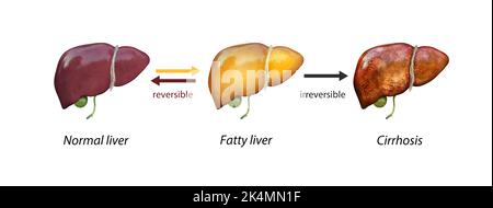 Fegato normale contro fegato con cirrosi, fegato danneggiato, fegato grasso, eccessivo consumo di alcol, trattamento, 3D rendering Foto Stock