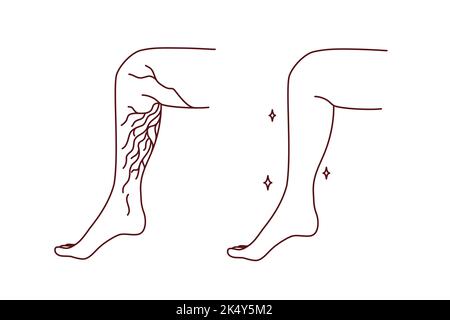 Primo piano della gamba sana e malsana con vene varicose. Il paziente soffre di varicosi. Sanità e medicina. Illustrazione vettoriale. Illustrazione Vettoriale