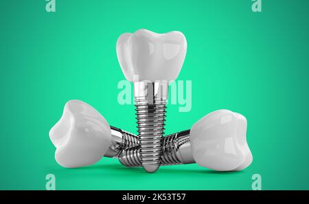 impianti dentali su sfondo verde. rendering 3d. Foto Stock