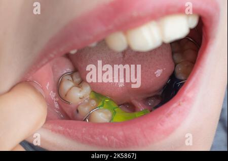 Piatto mandibolare, ragazzo che indossa l'allineatore dei denti, denti e piatto in dettaglio. Foto Stock