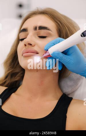 Macro primo piano dettaglio della penna al plasma laser che rimuove la verruca facciale sulla giovane donna. Trattamento cosmetico non invasivo Foto Stock