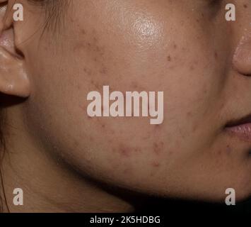 Acne, macchie nere e cicatrici sulla faccia della giovane donna asiatica. Foto Stock