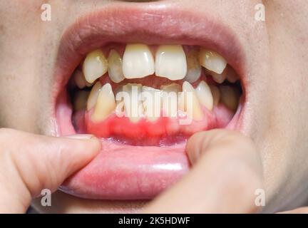 Infiammazione delle gengive chiamata gengivite. Problema parodontale. Scarsa igiene orale. Foto Stock