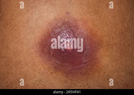 Grande carbuncle o ascesso alla parte posteriore della paziente femmina birmana asiatica. Foto Stock