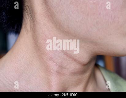 Invecchiamento della pelle pieghe o pieghe della pelle o rughe al collo del sud-est asiatico, cinese giovane uomo. Foto Stock