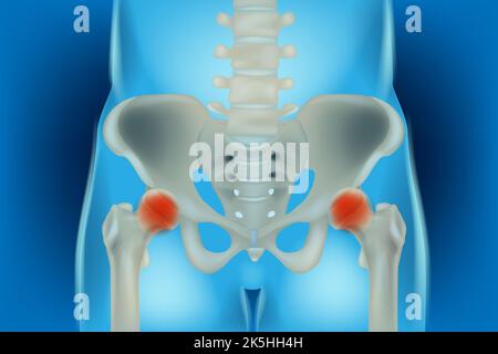 Ossa del bacino e dell'anca, anatomia umana, dolore alle articolazioni ossee del femore, raggi X dell'articolazione dell'anca e del femore. Osteonecrosi dell'anca. Foto Stock