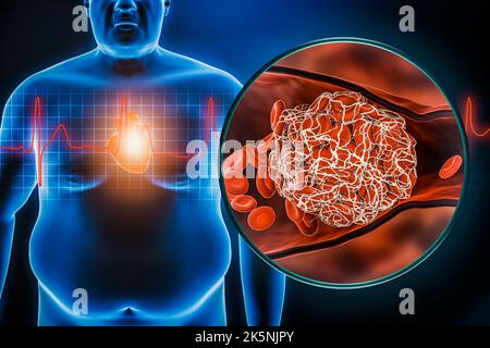 Illustrazione del rendering Heart Attack o Stroke 3D. Corpo toracico dell'uomo grasso o obeso con stemi ekg e coagulo di sangue. Obesità, sanità, medico, cardiovascu Foto Stock