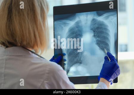 Medico pulmonologo guardando a raggi X sparare di polmoni Foto Stock