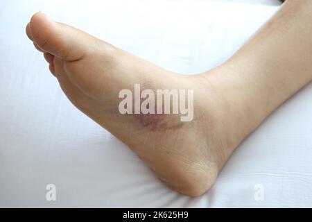 primo piano dei piedi delle donne con gonfiore Foto Stock