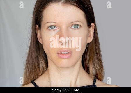Il volto di una giovane ragazza è diviso in due metà con e senza ritocco del viso con sette pimples e arrossamento, prima e dopo il trattamento del viso Foto Stock
