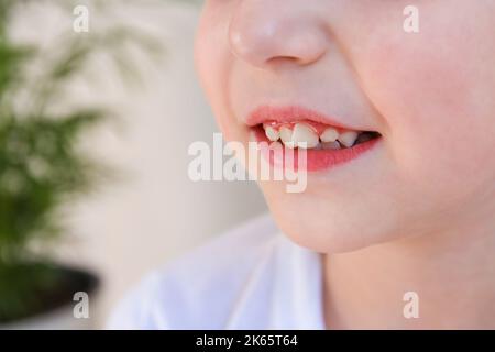 Il bambino ha denti storto. Il concetto di coronamento di molari. Foto Stock