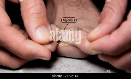 Primo piano del piede scalzo di un uomo che soffre del piede dell'atleta Foto Stock