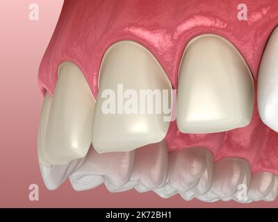Preparazione dei denti per la procedura di installazione della impiallacciatura sull'incisore centrale e sull'incisivo laterale. Illustrazione del dente 3D accurata dal punto di vista medico Foto Stock