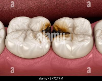 Denti molari danneggiati dalla carie. Illustrazione del dente 3D accurata dal punto di vista medico. Foto Stock