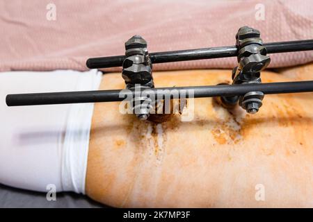 dispositivo di fissaggio esterno sull'anca in pazienti con frattura pelvica (focalizzazione sull'asta di primo piano) Foto Stock