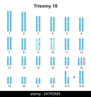 Progettazione scientifica della sindrome di Edwards (Trisomy 18) Karyotype. Simboli colorati. Illustrazione vettoriale. Illustrazione Vettoriale