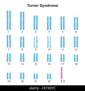 Progettazione scientifica della sindrome di Turner (monosomia X) Karyotype. Simboli colorati. Illustrazione vettoriale. Illustrazione Vettoriale