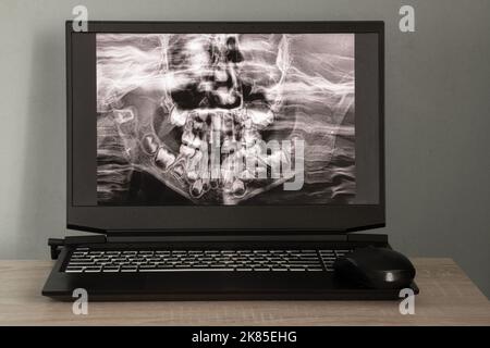 Raggi X panoramici dei denti dei bambini di due mascelle, ortopantomogramma dei denti dei bambini sugli schermi dei computer portatili sul tavolo Foto Stock