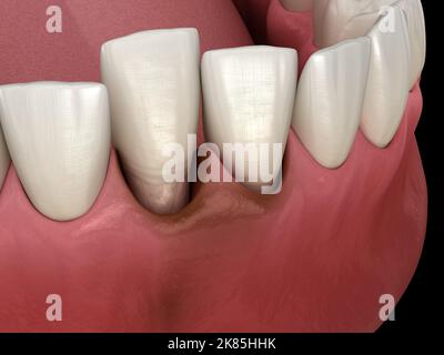 Dislocazione dei denti dopo trauma. Illustrazione 3D accurata dal punto di vista medico Foto Stock