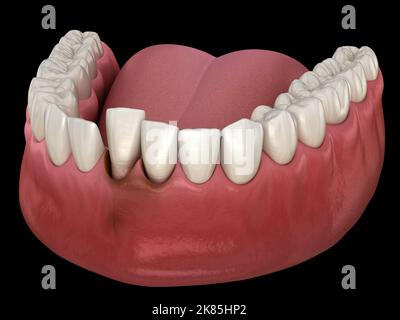 Dislocazione dei denti dopo trauma. Illustrazione 3D accurata dal punto di vista medico Foto Stock