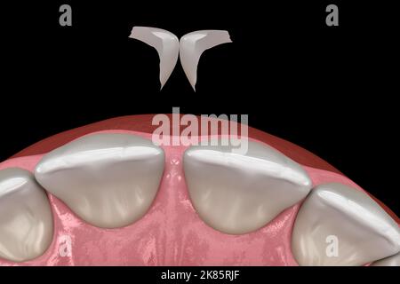 Trattamento diastema: Procedura di installazione di micro impiallacciatura sull'incisore centrale. Illustrazione del dente 3D accurata dal punto di vista medico Foto Stock