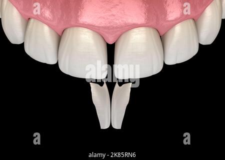 Trattamento diastema: Procedura di installazione di micro impiallacciatura sull'incisore centrale. Illustrazione del dente 3D accurata dal punto di vista medico Foto Stock