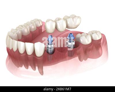 Ponte dentale sostenuti da impianti. Accurata dal punto di vista medico 3D illustrazione dei denti umani e le dentiere concept Foto Stock