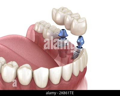 Ponte dentale sostenuti da impianti. Accurata dal punto di vista medico 3D illustrazione dei denti umani e le dentiere concept Foto Stock