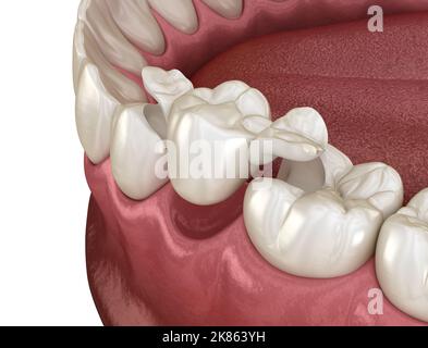 Ponte del Maryland in ceramica, recupero del dente premolare. Illustrazione 3D accurata dal punto di vista medico del concetto dentale Foto Stock