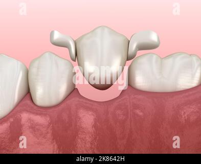 Ponte del Maryland in ceramica, recupero del dente premolare. Illustrazione 3D accurata dal punto di vista medico del concetto dentale Foto Stock