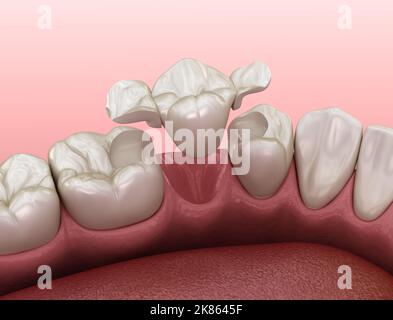 Ponte del Maryland in ceramica, recupero del dente premolare. Illustrazione 3D accurata dal punto di vista medico del concetto dentale Foto Stock