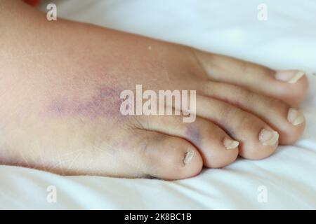 primo piano dei piedi delle donne con gonfiore sul letto Foto Stock