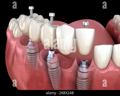 Ponte dentale basato su impianti 3. Illustrazione 3D accurata dal punto di vista medico del concetto di denti umani e protesi dentarie Foto Stock