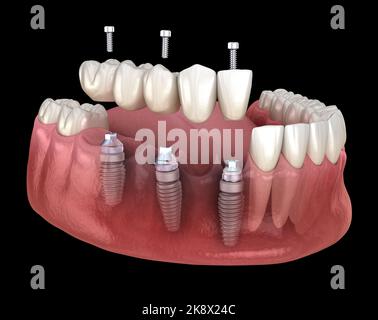 Ponte dentale basato su impianti 3. Illustrazione 3D accurata dal punto di vista medico del concetto di denti umani e protesi dentarie Foto Stock