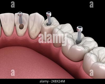 Ponte dentale basato su impianti 3. Illustrazione 3D accurata dal punto di vista medico del concetto di denti umani e protesi dentarie Foto Stock