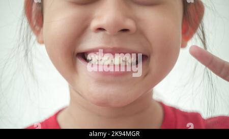 Felice bambino asiatico in rosso mostrando i suoi denti decaduto in fuoco selettivo Foto Stock