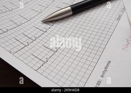 Elettrocardiogramma (ECG o ECG) con possibile aritmia. Foto Stock