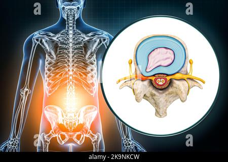 Ernia lombare e vertebra con disegno medico del disco erniato 3D che rende l'illustrazione. Mal di schiena, patologie della colonna vertebrale, lesioni, osteologia, assistenza sanitaria, sc Foto Stock